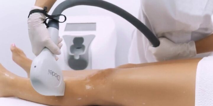 How does Laser Hair Removal work?