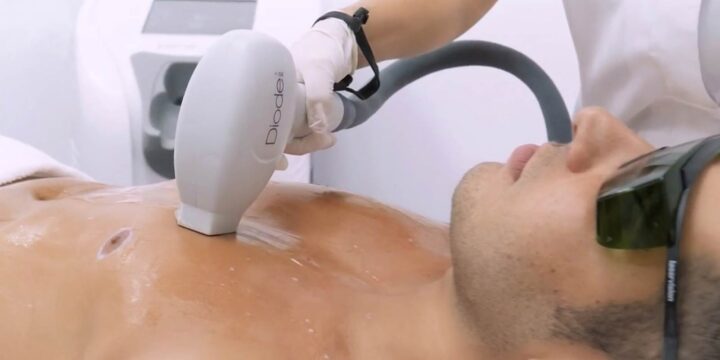 Science behind Laser Hair Removal
